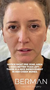 Voluma Fillers on Chin, Zygomatic Bone "Cheek Bone" and pre Jowl Area