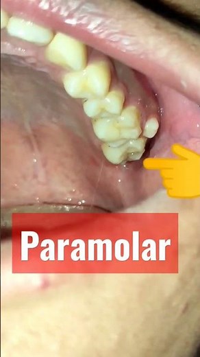 🇳🇵Paramolar! Supernumerary Tooth! Extra Tooth! Hyperdontia-Maxillary Arch-Extraction! Nepali Dentist