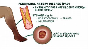 Video: Peripheral arterial disease and ulcers: Clinical sciences - Video Explanation! | Osmosis | Osmosis