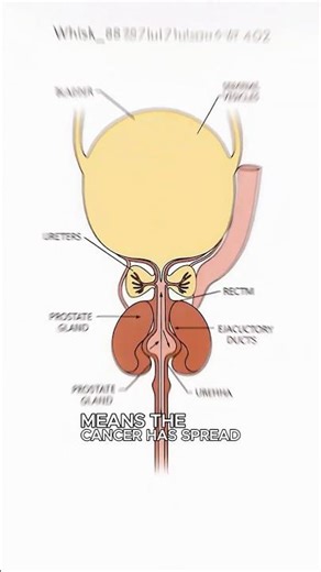 STAGE 4 PROSTATE CANCER EXPLAINED