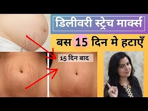 गर्भावस्था के स्ट्रेच मार्क्स हटाने के घरेलू नुस्खे | how to remove pregnancy stretch marks in Hindi