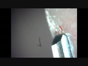 鼻のコメドを除去