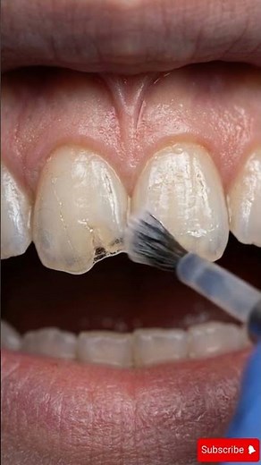 😬 Chipped Tooth Fixed Perfectly | Realistic Dental Repair Animation Step by Step#toothfix #3DTeeth