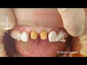 Emax Crown Cementation #dentist #dentistry #dental #cosmeticdentistry