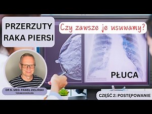 Odcinek 148. Czy zawsze usuwamy przerzuty raka piersi do płuc?