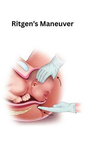 AIIMS NORCET Image Question | Ritgen Maneuver 🏥#ritgenmaneuver