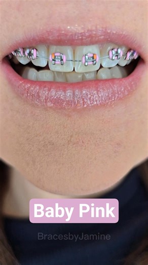 Braces Colors Before and After 4 weeks