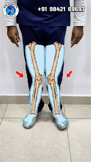 Knee Deformity Correction Exercise That Actually Works! Struggling with knee pain or knee deformity? This quick and easy exercise helps improve knee alignment, reduce discomfort, and support better joint stability. Do this daily to strengthen your muscles, correct posture, and protect your knees from long-term damage. Suitable for: ✔ Knock Knees ✔ Bow Legs ✔ Knee Pain During Walking ✔ Weak Knee Muscles Try this simple routine and feel the improvement! 🦵✨ 🔔 Subscribe for more pain-relief tips, 