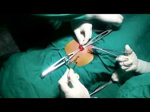 Mini-Laparotomy for Tubal Ligation | Safe, Simple, & Pain-Free!