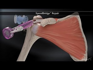 SpeedBridge™ Repair