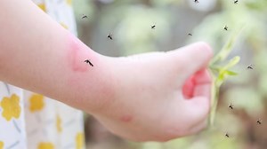 From Honey To Oatmeal: Try These Simple Home Remedies For Insect Bites