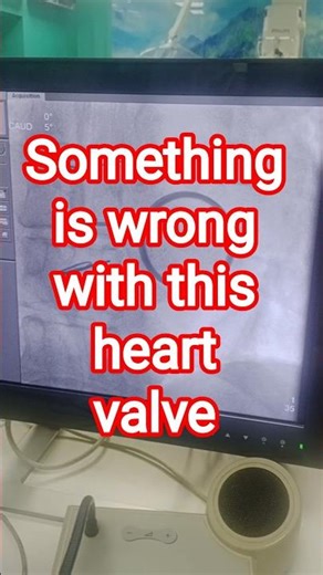 ⚠️ Stuck Mechanical Heart Valve – Fluoroscopy View