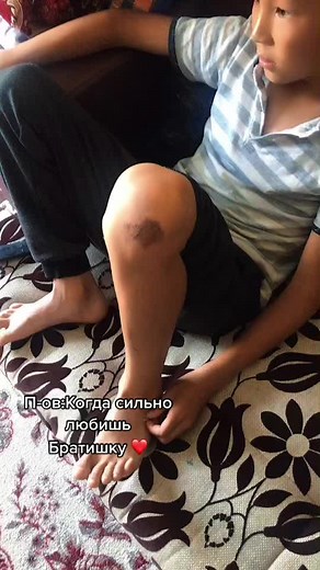 Understanding Bruises: Causes and Care Tips