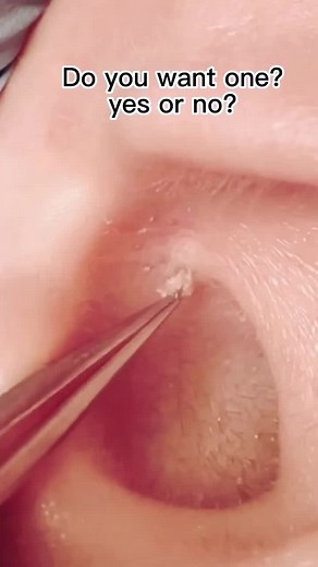 #pimplepopper #blackheadsremoval #satisfyingvideo #skincare #cystpopping #acne #pimple #removal #fyp #tiktok #pimplepop