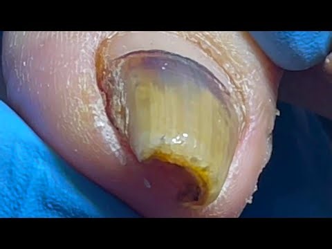 The Nails Are All Infected By Bacteria And Curl Up And Grow Inward【Pedicure Master Lin Jun】
