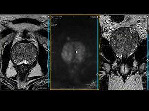 Prostate MRI — PI-RADS 2