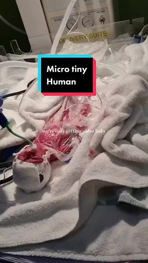 Micro preemie! Original vid: @kerryannnnaa | micro preemie