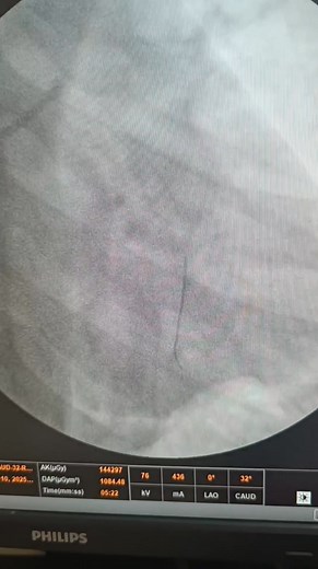 ACS/ STEMI/Inferoposterior wall MI, LCX 100℅ occluded, Primary PCI was done within first hour of arrival and patient was discharged on day 2 , Jaipur heart and general hospital , NNL | Practical Interventional Cardiology