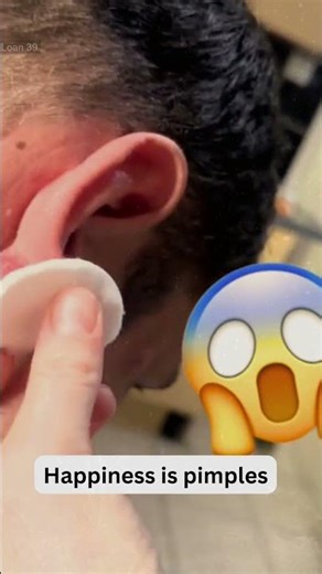 Deep Blackheads, Milia & Whitehead Removal pimple popping New| Big Cystic Acne Extraction #1228 2026