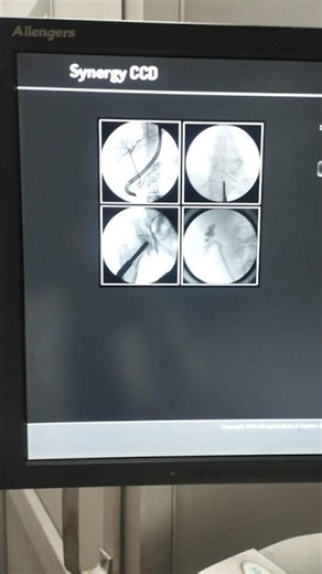 Live X-ray of swallowing☢️ #radiology#bariumswallow #xrays#flouroscopy#radtech #esophagus#ytshorts