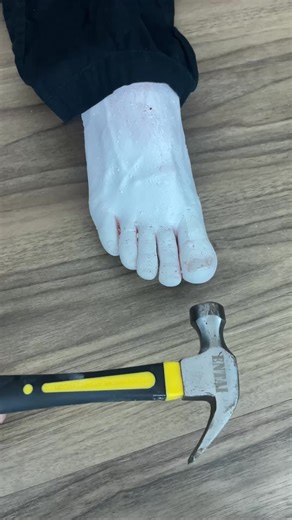 First Aid Tips for Frostbite Treatment