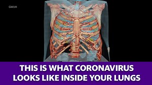 This 3-D model shows what coronavirus looks like inside your lungs