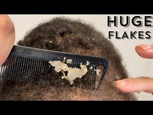 Lots of flakes | Satisfying ASMR #psoriasis #asmr #dandruffremoval