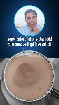 Umbilical hernia
