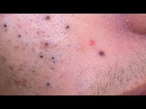 [ASMR] Satisfying Pore Cleaning and Blackhead Cleansing Routine