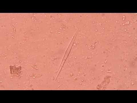 Charcoat leyden (CL) crystal in Stool Microscopy