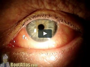 Corneal Dellen after cataract surgery (Video) - TimRoot.com