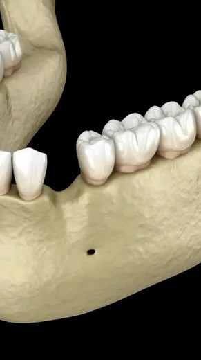 24K views · 303 reactions | How things work in dentistry : Dental implant surgery ( 3d Animation) #dentalimplantsurgery #dentalimplant #how #dental #dentistry #patienteducation #tooth #viral #trendingreels #fbreels #viralvideo | Dental Daily | Facebook