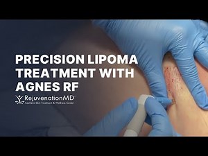 Non-Surgical Lipoma Treatment with Agnes RF