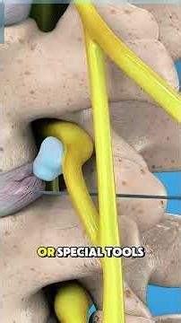 Sciatica Relief? See This Surgery #discharging #3dmedicalanimation #spinesurgery #surgery #3d