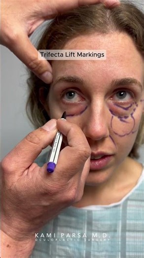Stunning Lower Eye Bag Transformation (Before and After) Dr. Kami Parsa Trifecta Lift