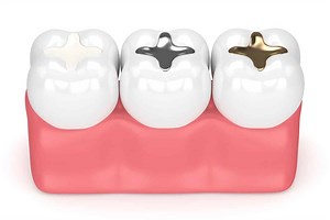 Silver Filling vs White Filling: Which is Better? | Blossom