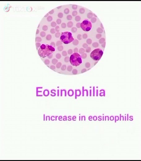 Abnormal White Blood Cell Findings Explained | Basophilia and Hematology Review #viralvideo #fypシ