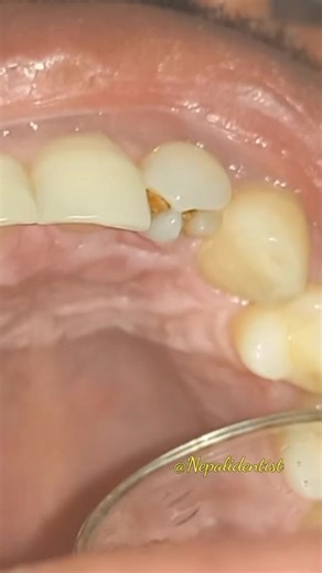 Strange tooth structure discovered, #tooth #fusion #abnormal #lateral #tooth #lifeofadentist #drbiplob #premierdentalnepal #strange #tooth #discovered