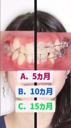 八重歯はどれくらいで治る？奈良の矯正歯科が解説｜氏井矯正歯科クリニック #歯医者 #八重歯矯正 #ワイヤー矯正 #奈良 #矯正 #歯並び矯正