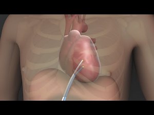 Cardiac Ablation Medical Device Animation