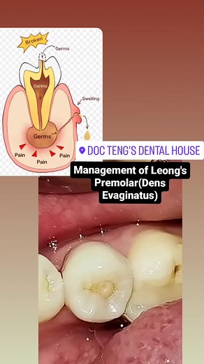 Management of Dens Evaginatus(Leong's Premolar) This is case of 19 years old female with chief complaint: May nana sa gilagid Dens evaginatus (DE) is a dental anomaly with a supernumerary tubercle projection that typically contains dentin and pulp tissue. However, the tubercle projection can fracture, exposing the dentin and potentially the dental pulp, which induces pulpal diseases. treatment Done: LSTR and Root Canal Therapy restored with Bioceramic Restoration #OralhealthtungosaOverallHealth