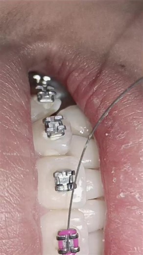 Understanding Braces and Retainers