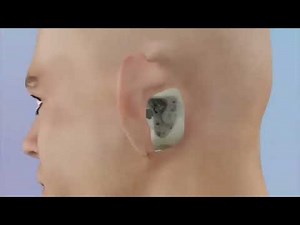 Wright Mastoid Surgery Animation | Basic to Radical Mastoidectomy Explained