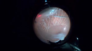 Vitrectomy for Diabetic Neovascular Glaucoma - Eyetube