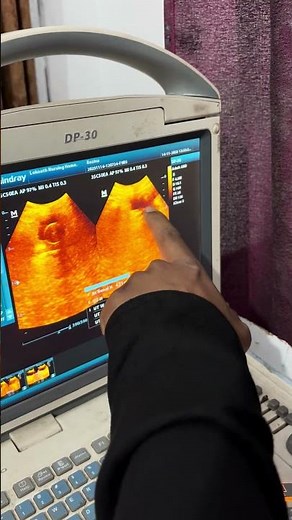 Urinary bladder mass or Polyp ultrasound #ultrasound #usg