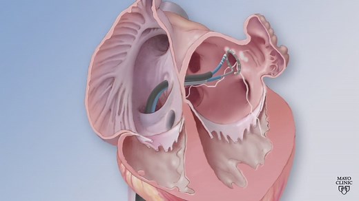 Cardiac ablation for atrial fibrillation - Mayo Clinic