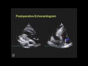 Left ventricular apical aneurysm resection in hypertrophic cardiomyopathy