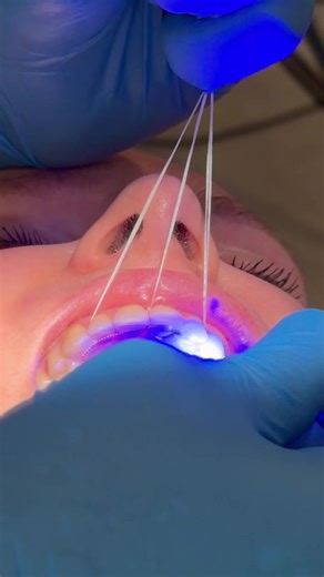 Quick Fixed Retainer Installation in Less Than 10 Minutes