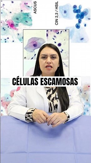 Te explicamos qué son las células escamosas que te detectaron en tu chequeo 💡