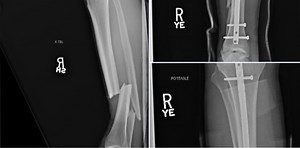 Chris Weidman shares x-ray of broken leg